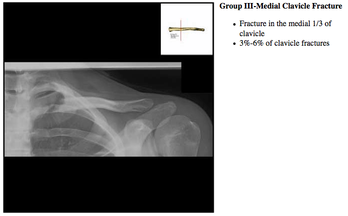 Clavicle FractureMedial S42.023A 810.02 eORIF